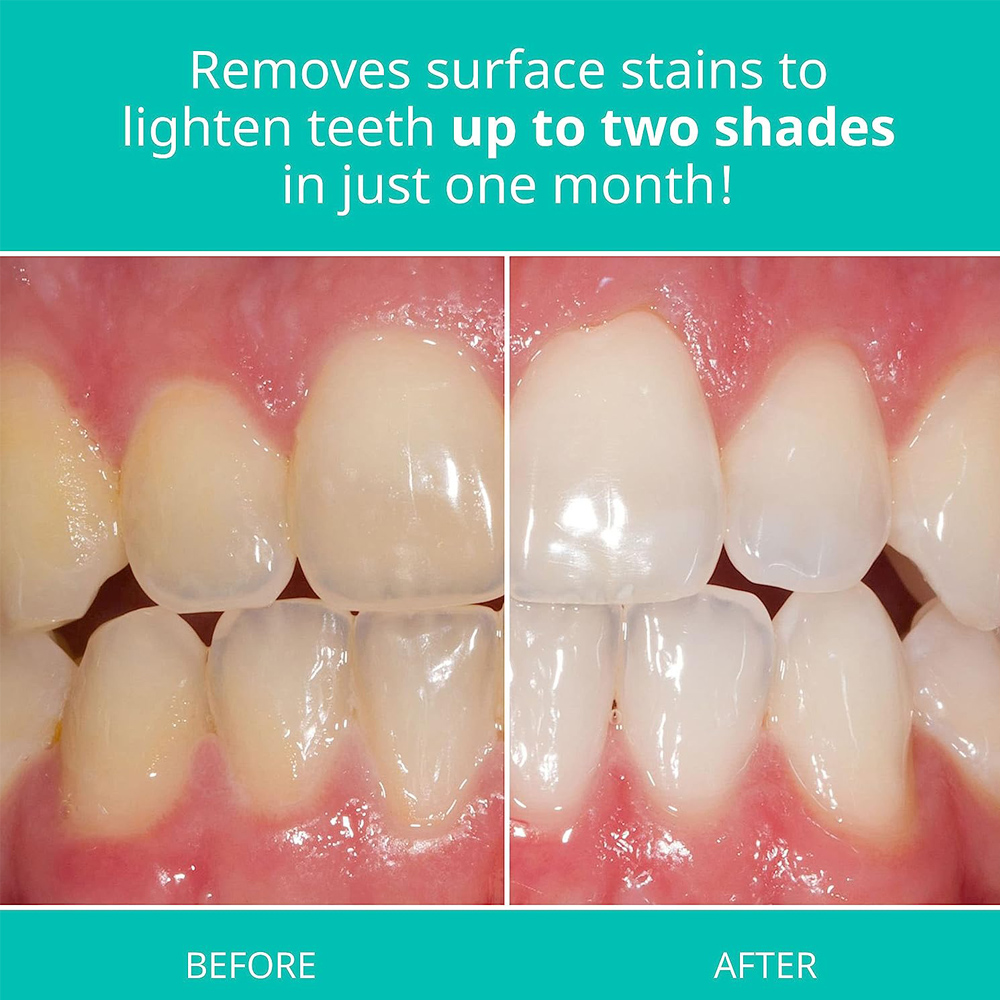 Opalescence beyazlatma diş mac - Teeth Whitening Opalescence incelemesi ve fiyatı