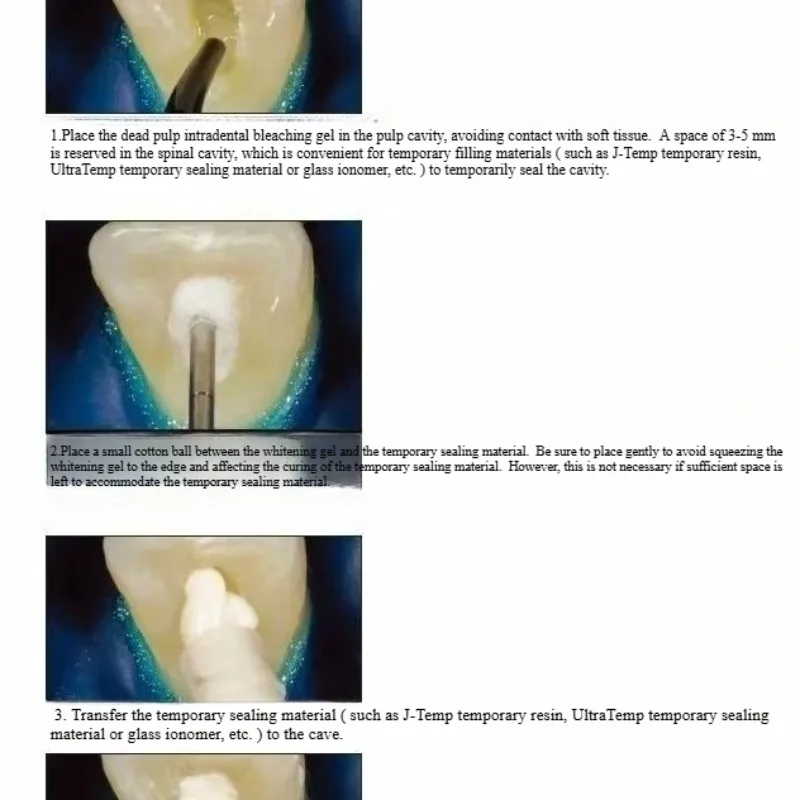 Diş Restorasyon Malzemeleri Öl - Teeth Whitening Effects incelemesi ve fiyatı
