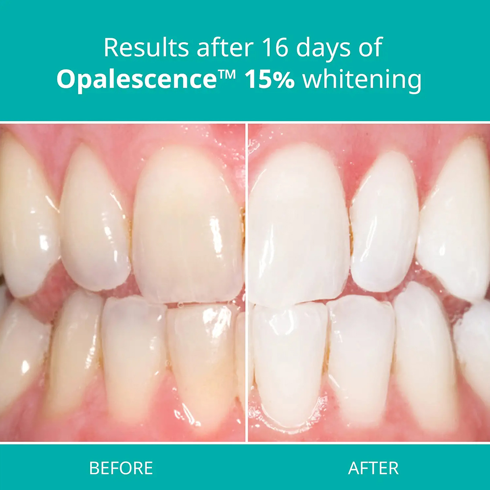 Opalescence Profesyonel Beyazl - Teeth Whitening Opalescence incelemesi ve fiyatı