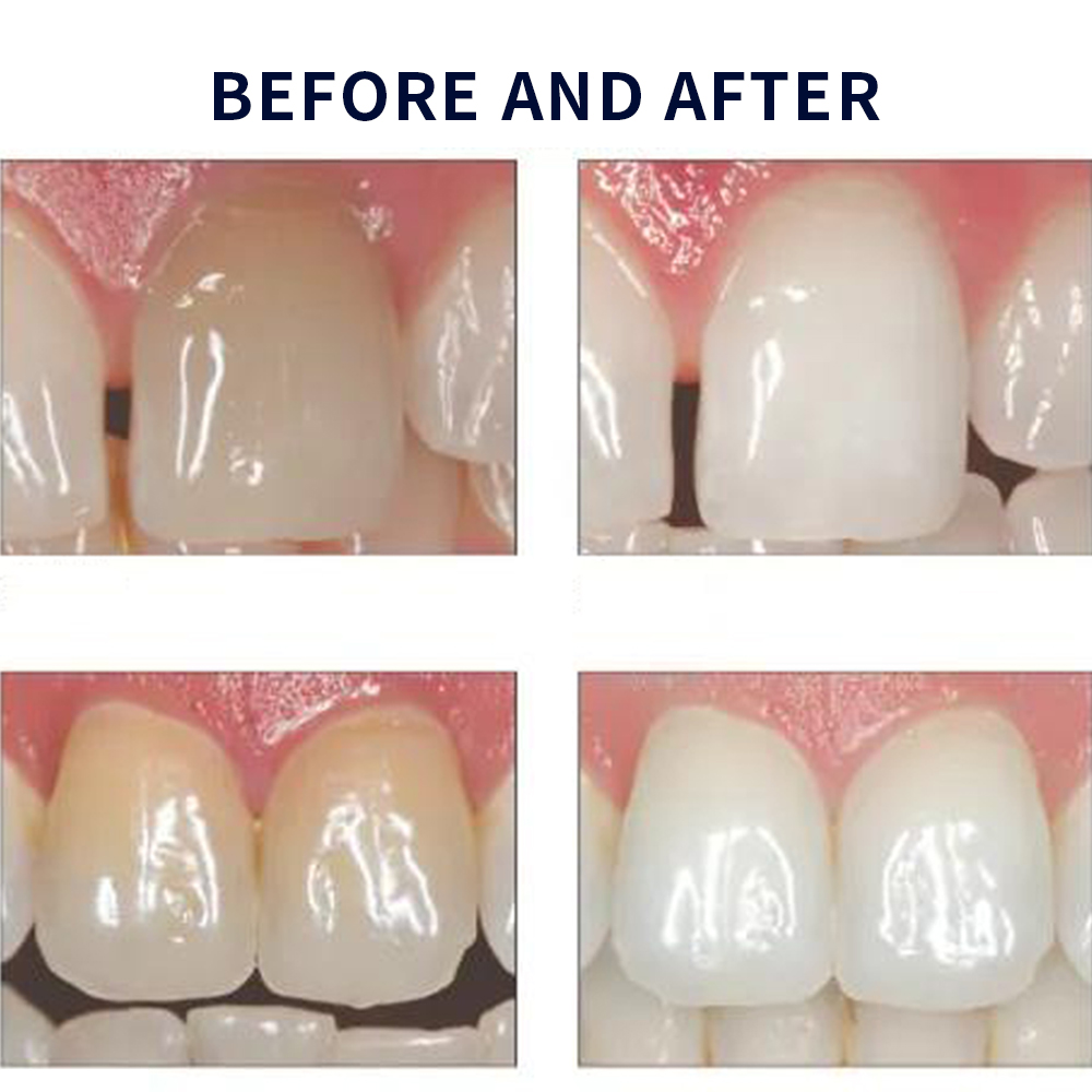 Opalescence beyazlatma 20% PF  - Teeth Whitening Kit At Home incelemesi ve fiyatı