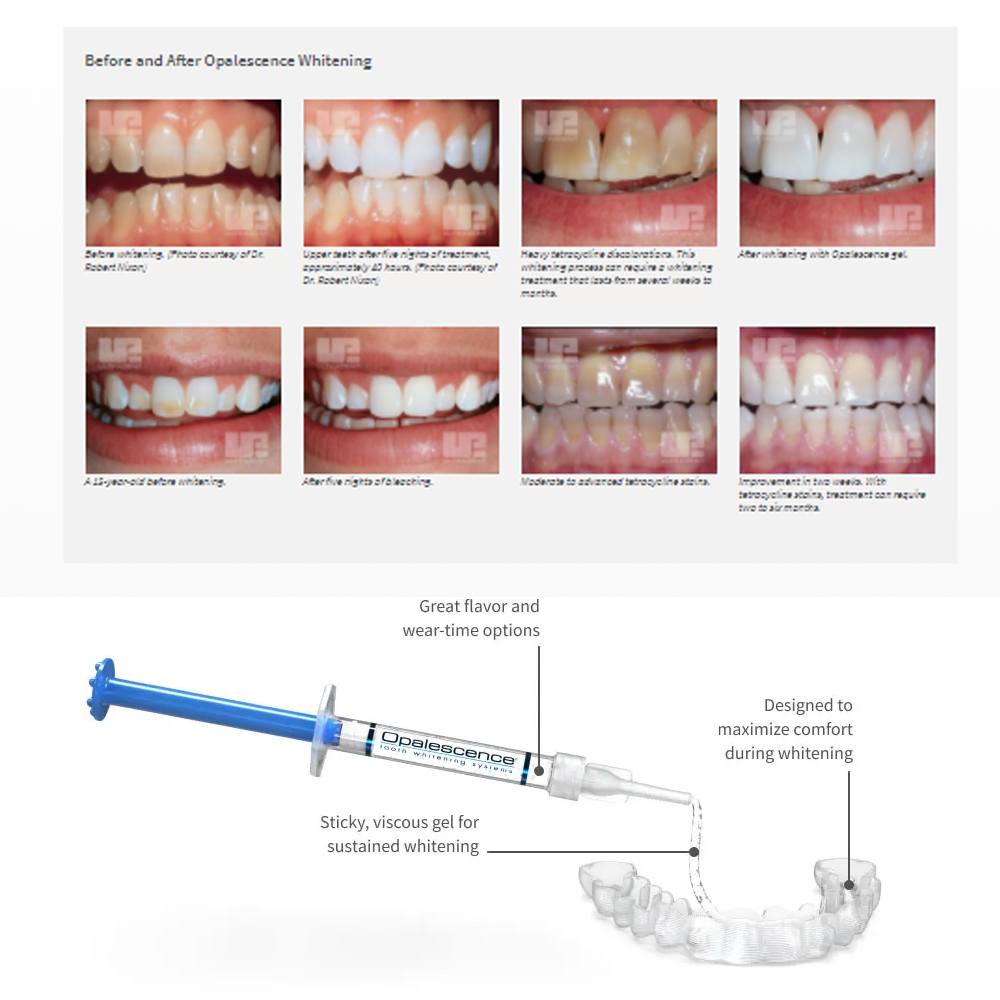 Opalescence beyazlatma 20% PF  - Teeth Whitening Kit At Home incelemesi ve fiyatı