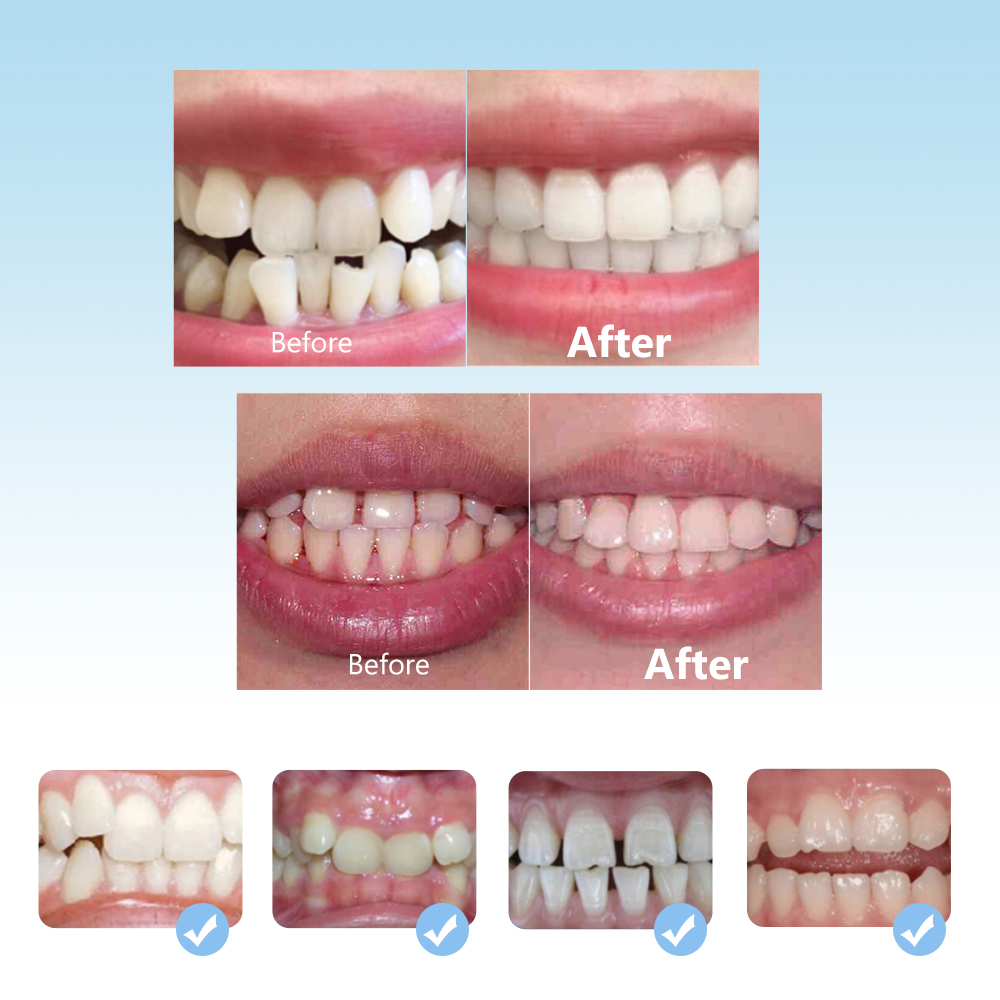 Diş ortodonti parantez seti 3  - Teeth Whitening Mouth Guard incelemesi ve fiyatı