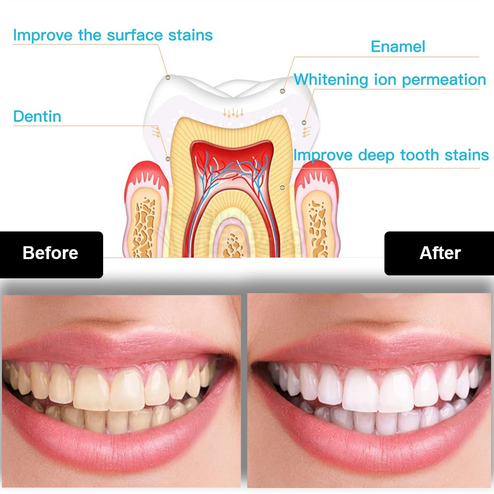 Diş Diş Beyazlatma Kiti Mini 1 - Teeth Whitening Opalescence incelemesi ve fiyatı