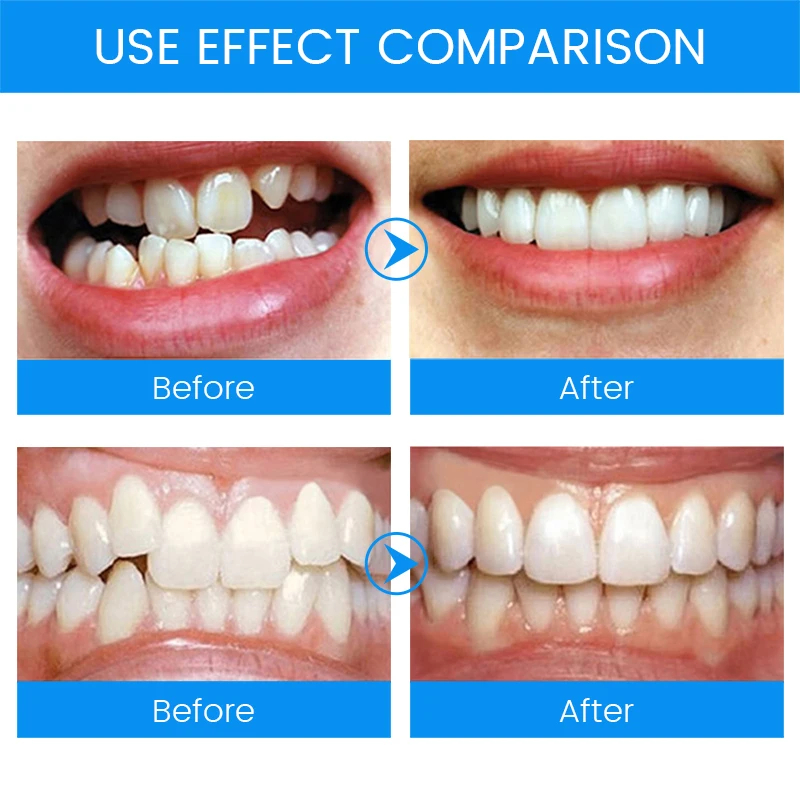 3 aşamalı diş ortodonti diş te - Teeth Whitening Mouth Guard incelemesi ve fiyatı