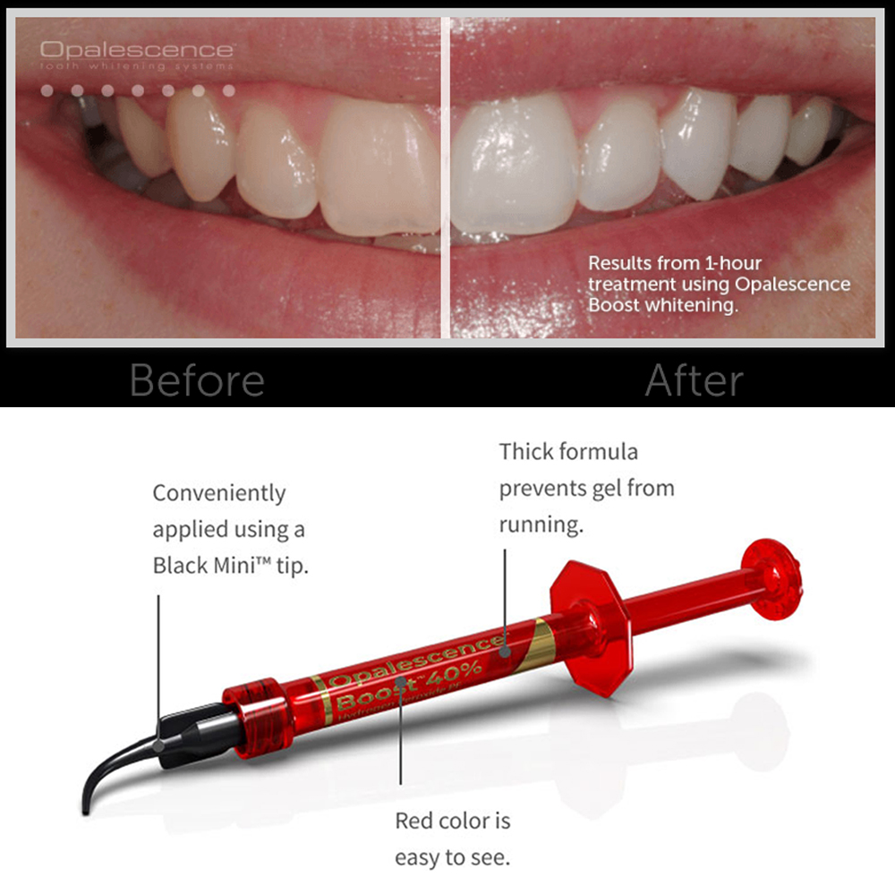 Ultradent Opalescence Boost PF - Teeth Whitening Opalescence incelemesi ve fiyatı